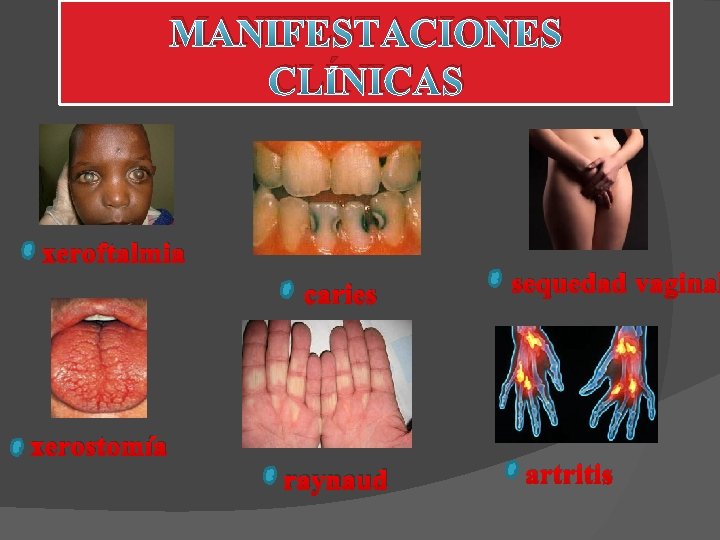 MANIFESTACIONES CLÍNICAS xeroftalmia caries xerostomía raynaud sequedad vaginal artritis 