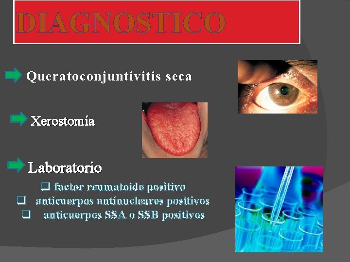 DIAGNOSTICO Queratoconjuntivitis seca Xerostomía Laboratorio q factor reumatoide positivo q anticuerpos antinucleares positivos q