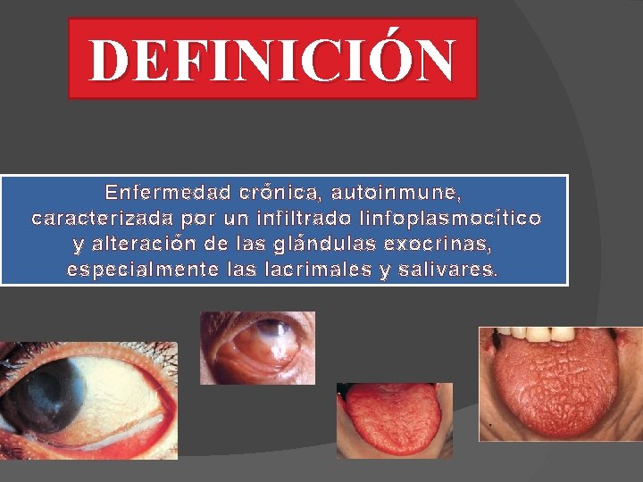 DEFINICIÓN Enfermedad crónica, autoinmune, caracterizada por un infiltrado linfoplasmocítico y alteración de las glándulas