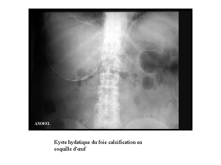 Kyste hydatique du foie calcification en coquille d'œuf 