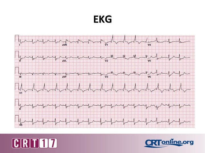 EKG 