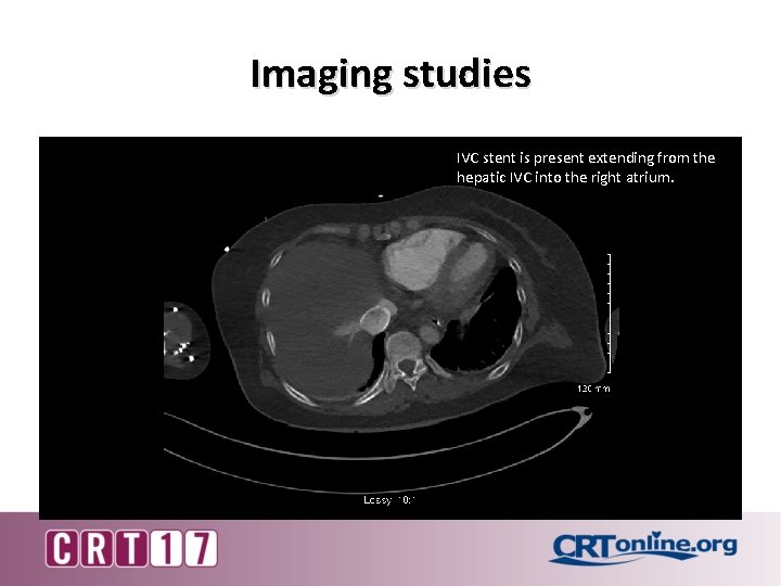 Imaging studies IVC stent is present extending from the hepatic IVC into the right