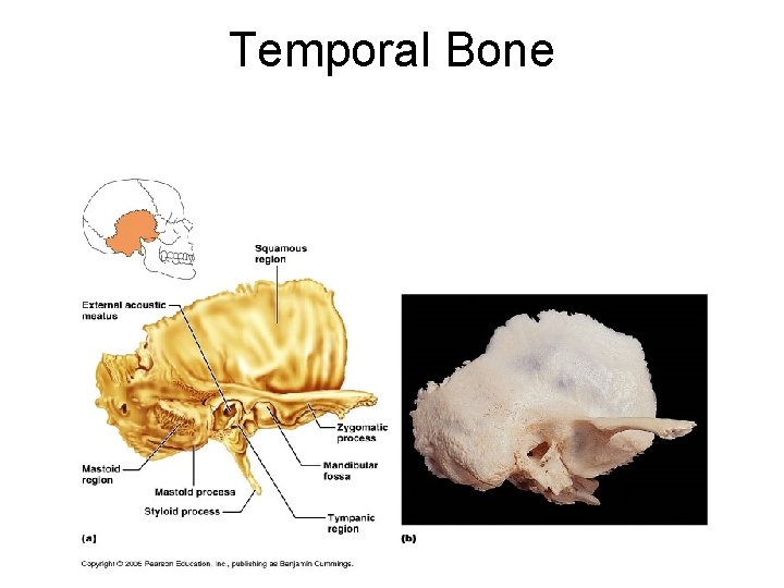 Temporal Bone 