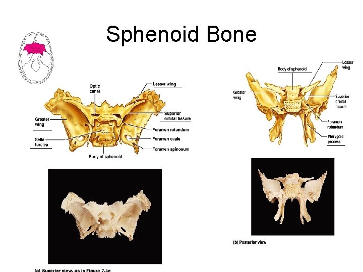 Sphenoid Bone 