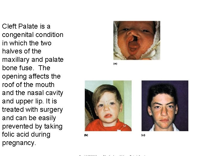 Cleft Palate is a congenital condition in which the two halves of the maxillary