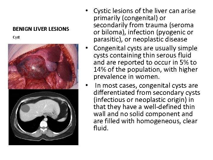 BENIGN LIVER LESIONS Cyst • Cystic lesions of the liver can arise primarily (congenital)
