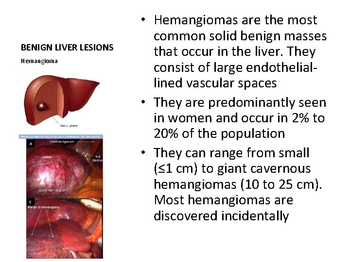 BENIGN LIVER LESIONS Hemangioma • Hemangiomas are the most common solid benign masses that