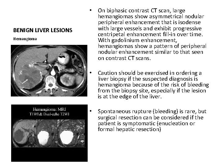 BENIGN LIVER LESIONS Hemangioma • On biphasic contrast CT scan, large hemangiomas show asymmetrical