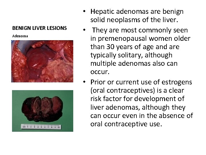 BENIGN LIVER LESIONS Adenoma • Hepatic adenomas are benign solid neoplasms of the liver.