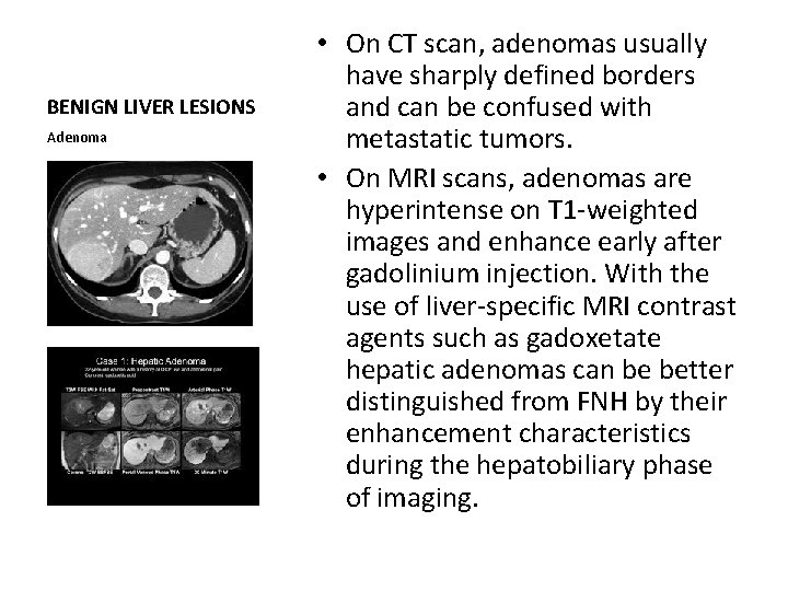 BENIGN LIVER LESIONS Adenoma • On CT scan, adenomas usually have sharply defined borders