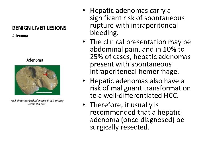 BENIGN LIVER LESIONS Adenoma • Hepatic adenomas carry a significant risk of spontaneous rupture