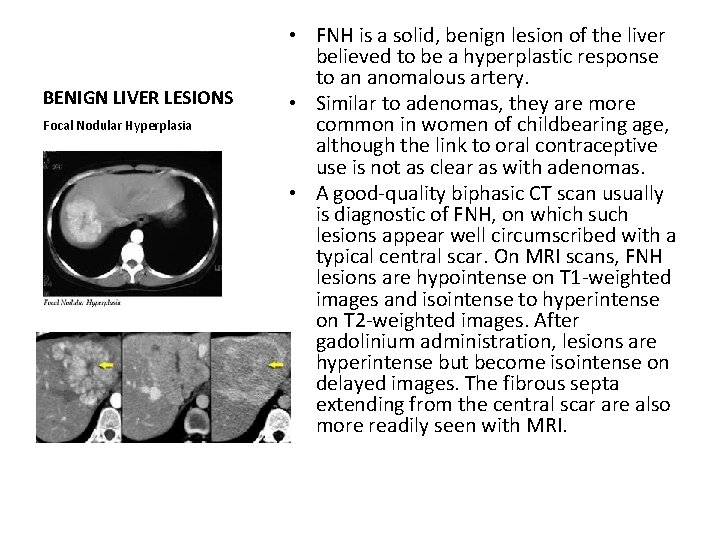 BENIGN LIVER LESIONS Focal Nodular Hyperplasia • FNH is a solid, benign lesion of