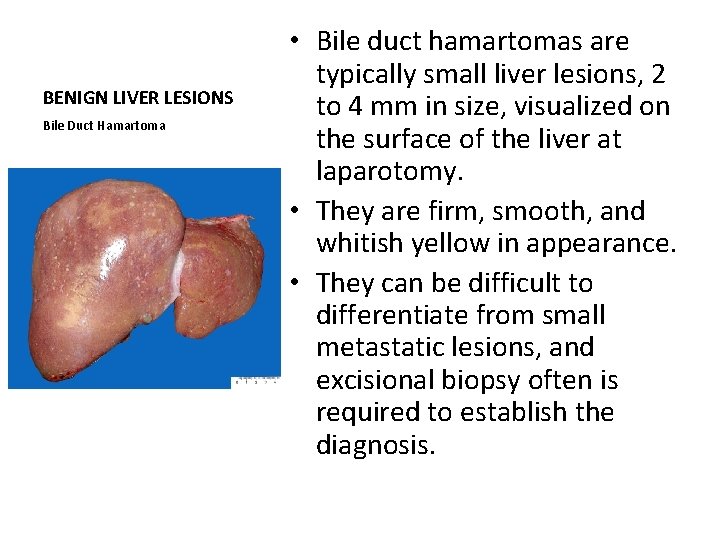 BENIGN LIVER LESIONS Bile Duct Hamartoma • Bile duct hamartomas are typically small liver