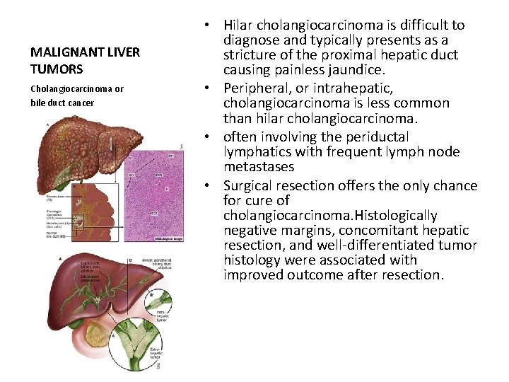 MALIGNANT LIVER TUMORS Cholangiocarcinoma or bile duct cancer • Hilar cholangiocarcinoma is difficult to