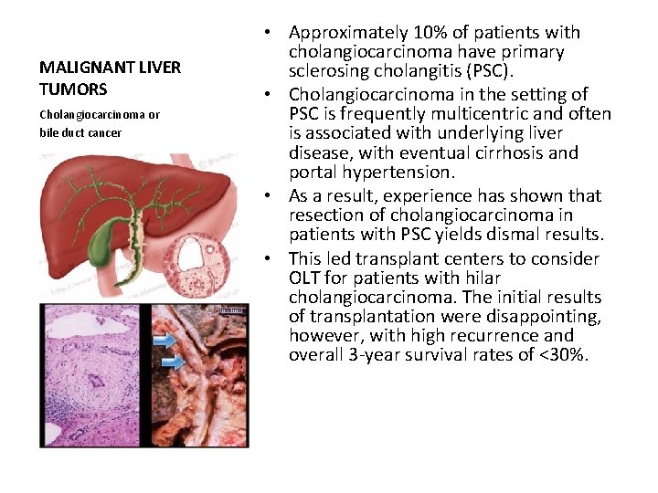 MALIGNANT LIVER TUMORS Cholangiocarcinoma or bile duct cancer • Approximately 10% of patients with