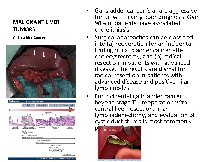 MALIGNANT LIVER TUMORS Gallbladder Cancer • Gallbladder cancer is a rare aggressive tumor with