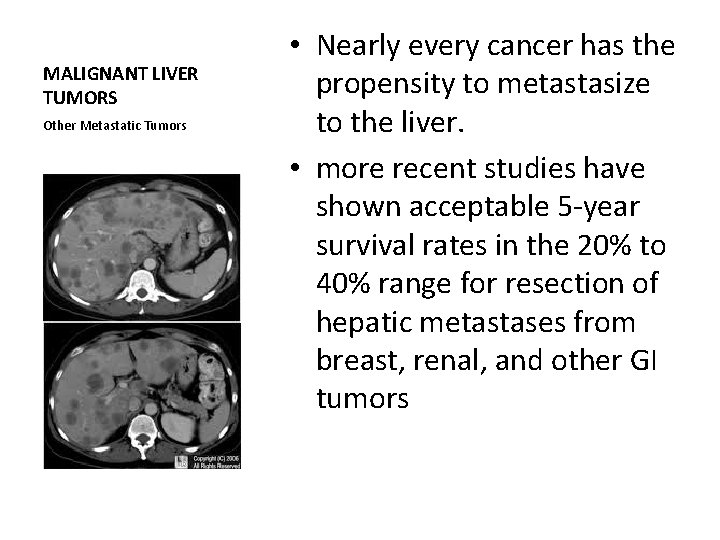 MALIGNANT LIVER TUMORS Other Metastatic Tumors • Nearly every cancer has the propensity to