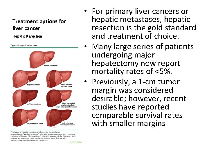 Treatment options for liver cancer Hepatic Resection • For primary liver cancers or hepatic