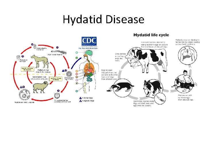 Hydatid Disease 