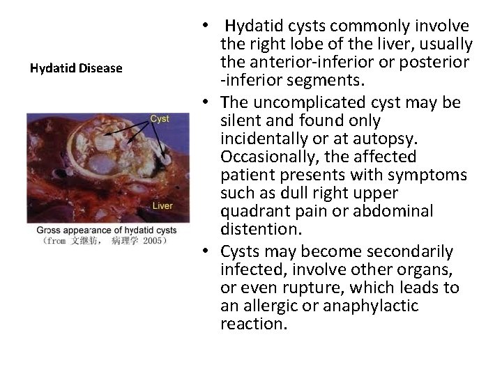 Hydatid Disease • Hydatid cysts commonly involve the right lobe of the liver, usually