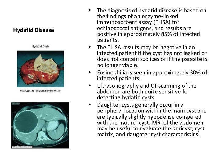Hydatid Disease • The diagnosis of hydatid disease is based on the findings of