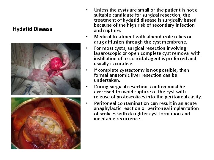  • Hydatid Disease • • • Unless the cysts are small or the