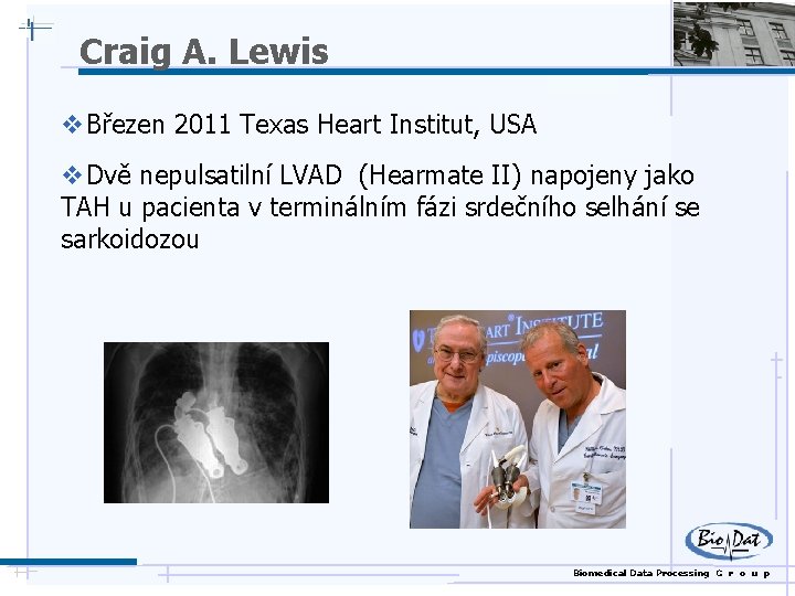 Craig A. Lewis v Březen 2011 Texas Heart Institut, USA v Dvě nepulsatilní LVAD