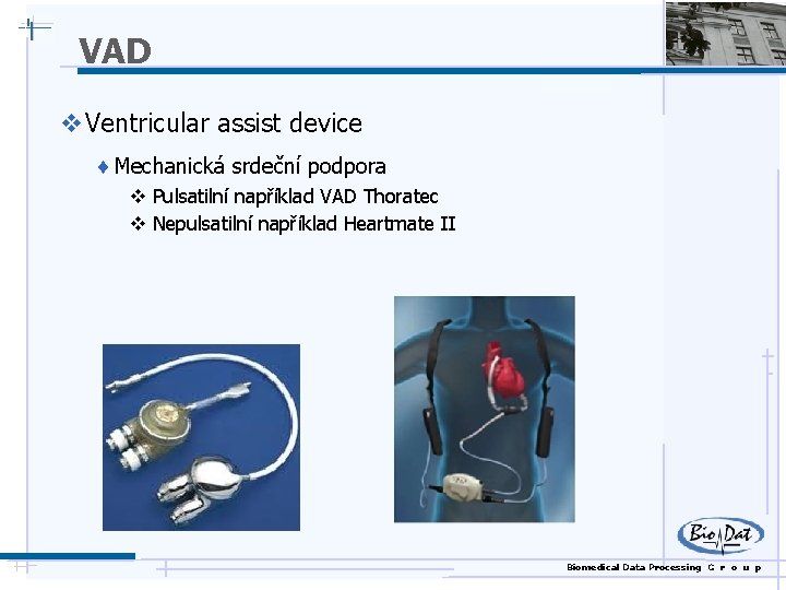 VAD v Ventricular assist device ¨ Mechanická srdeční podpora v Pulsatilní například VAD Thoratec