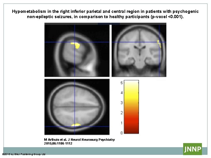 Hypometabolism in the right inferior parietal and central region in patients with psychogenic non-epileptic Hypometabolism in the right inferior parietal and central region in patients with psychogenic non-epileptic