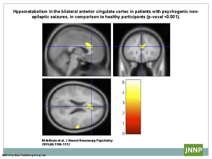 Hypometabolism in the bilateral anterior cingulate cortex in patients with psychogenic nonepileptic seizures, in Hypometabolism in the bilateral anterior cingulate cortex in patients with psychogenic nonepileptic seizures, in