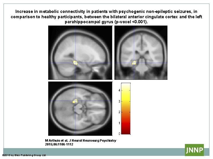 Increase in metabolic connectivity in patients with psychogenic non-epileptic seizures, in comparison to healthy Increase in metabolic connectivity in patients with psychogenic non-epileptic seizures, in comparison to healthy