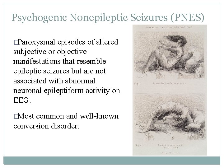 Psychogenic Nonepileptic Seizures (PNES) �Paroxysmal episodes of altered subjective or objective manifestations that resemble Psychogenic Nonepileptic Seizures (PNES) �Paroxysmal episodes of altered subjective or objective manifestations that resemble