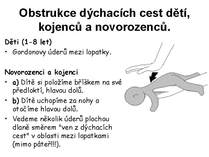 Obstrukce dýchacích cest dětí, kojenců a novorozenců. Děti (1 -8 let) • Gordonovy úderů