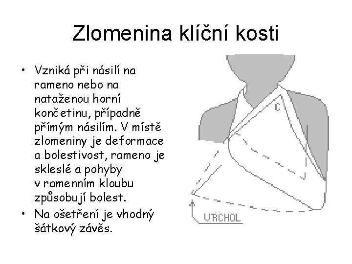 Zlomenina klíční kosti • Vzniká při násilí na rameno nebo na nataženou horní končetinu,