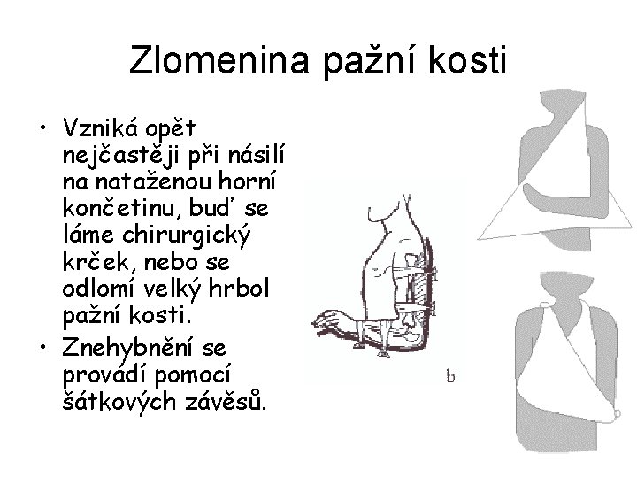 Zlomenina pažní kosti • Vzniká opět nejčastěji při násilí na nataženou horní končetinu, buď