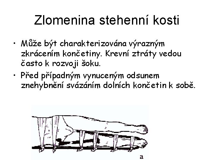 Zlomenina stehenní kosti • Může být charakterizována výrazným zkrácením končetiny. Krevní ztráty vedou často