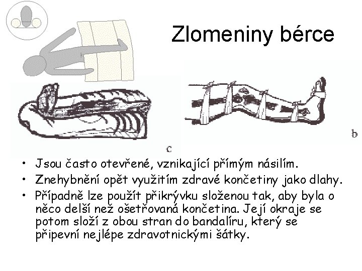 Zlomeniny bérce • Jsou často otevřené, vznikající přímým násilím. • Znehybnění opět využitím zdravé