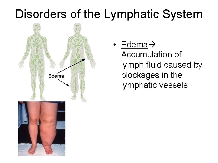 Disorders of the Lymphatic System • Edema Accumulation of lymph fluid caused by blockages
