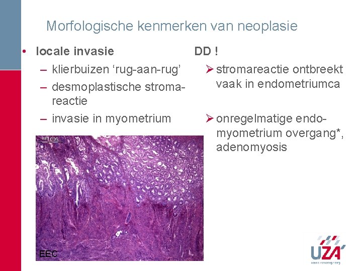 Morfologische kenmerken van neoplasie DD ! • locale invasie Ø stromareactie ontbreekt – klierbuizen Morfologische kenmerken van neoplasie DD ! • locale invasie Ø stromareactie ontbreekt – klierbuizen
