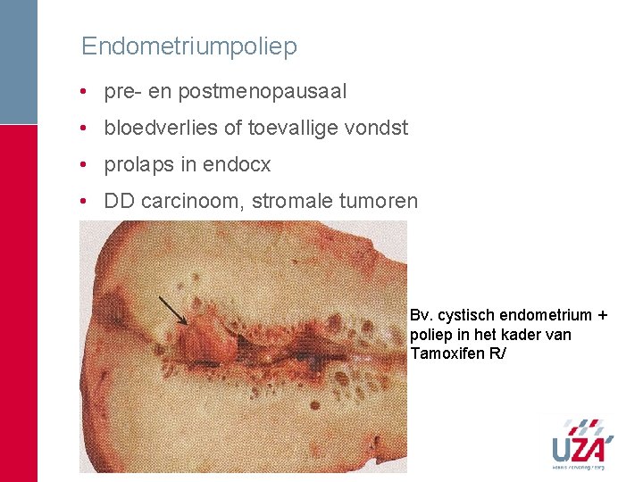 Endometriumpoliep • pre- en postmenopausaal • bloedverlies of toevallige vondst • prolaps in endocx Endometriumpoliep • pre- en postmenopausaal • bloedverlies of toevallige vondst • prolaps in endocx