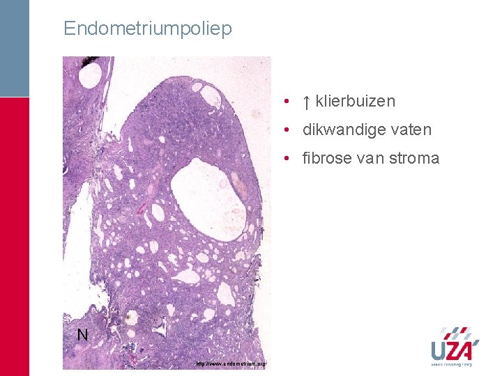 Endometriumpoliep • ↑ klierbuizen • dikwandige vaten • fibrose van stroma N http: //www. Endometriumpoliep • ↑ klierbuizen • dikwandige vaten • fibrose van stroma N http: //www.