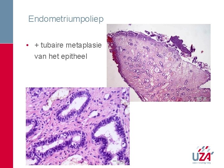Endometriumpoliep • + tubaire metaplasie van het epitheel Endometriumpoliep • + tubaire metaplasie van het epitheel