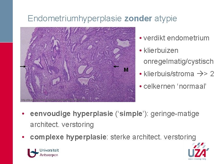 Endometriumhyperplasie zonder atypie • verdikt endometrium • klierbuizen onregelmatig/cystisch M • klierbuis/stroma > 2 Endometriumhyperplasie zonder atypie • verdikt endometrium • klierbuizen onregelmatig/cystisch M • klierbuis/stroma > 2
