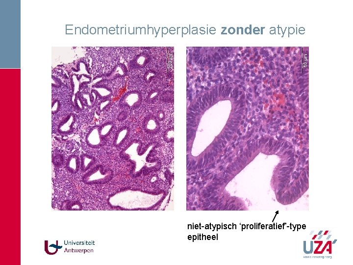 Endometriumhyperplasie zonder atypie niet-atypisch ‘proliferatief’-type epitheel Endometriumhyperplasie zonder atypie niet-atypisch ‘proliferatief’-type epitheel