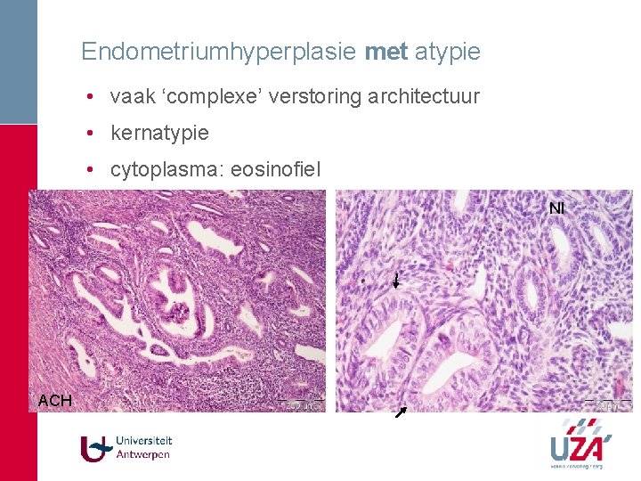 Endometriumhyperplasie met atypie • vaak ‘complexe’ verstoring architectuur • kernatypie • cytoplasma: eosinofiel Nl Endometriumhyperplasie met atypie • vaak ‘complexe’ verstoring architectuur • kernatypie • cytoplasma: eosinofiel Nl