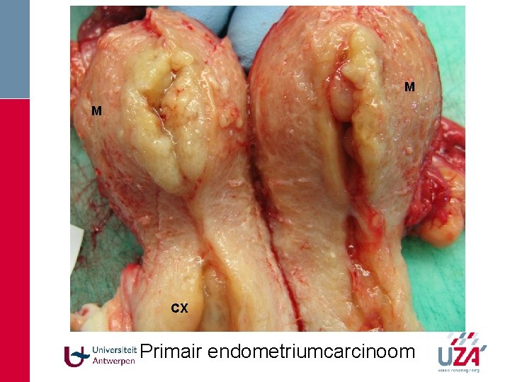 M M CX Primair endometriumcarcinoom M M CX Primair endometriumcarcinoom