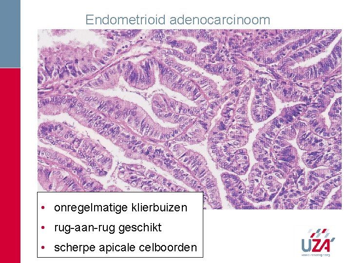 Endometrioid adenocarcinoom • onregelmatige klierbuizen • rug-aan-rug geschikt • scherpe apicale celboorden Endometrioid adenocarcinoom • onregelmatige klierbuizen • rug-aan-rug geschikt • scherpe apicale celboorden