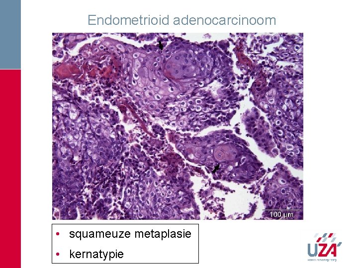 Endometrioid adenocarcinoom • squameuze metaplasie • kernatypie Endometrioid adenocarcinoom • squameuze metaplasie • kernatypie