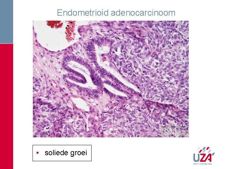 Endometrioid adenocarcinoom • soliede groei Endometrioid adenocarcinoom • soliede groei