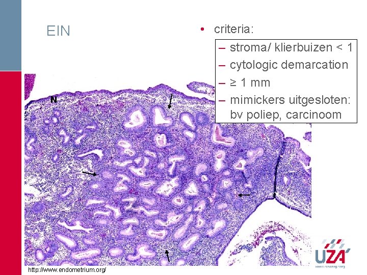 EIN N http: //www. endometrium. org/ • criteria: – stroma/ klierbuizen < 1 – EIN N http: //www. endometrium. org/ • criteria: – stroma/ klierbuizen < 1 –